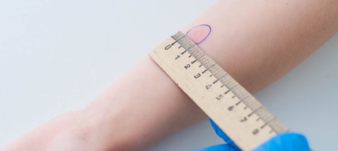 TB Skin Test Clinic in Los Banos, CA TB Skin Test Clinic in Los Banos, CA