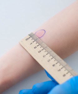 TB Skin Test Clinic in Los Banos, CA - Los Banos Primary Care, Inc.